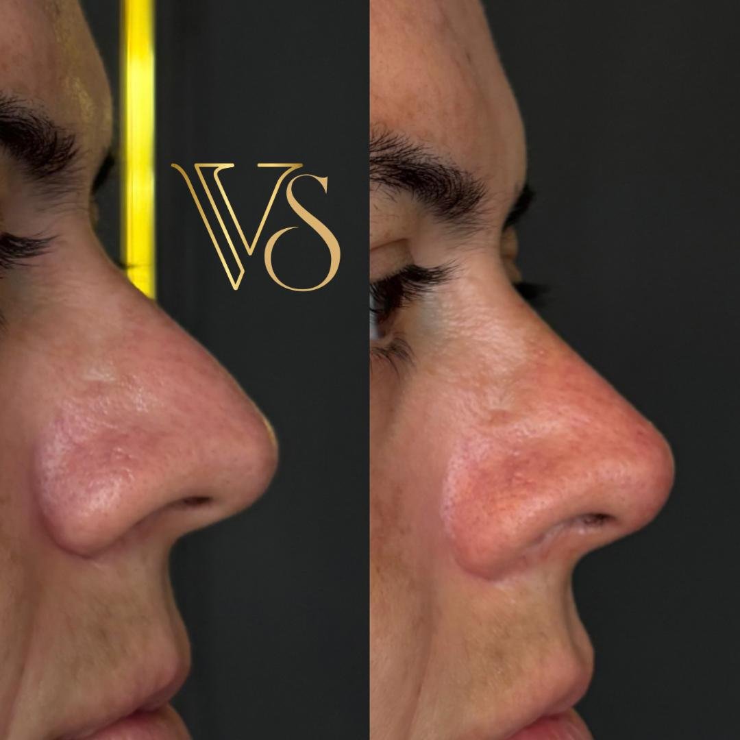 Rinomodelação Dra Vanessa Silveira Castro e Ponta Grossa