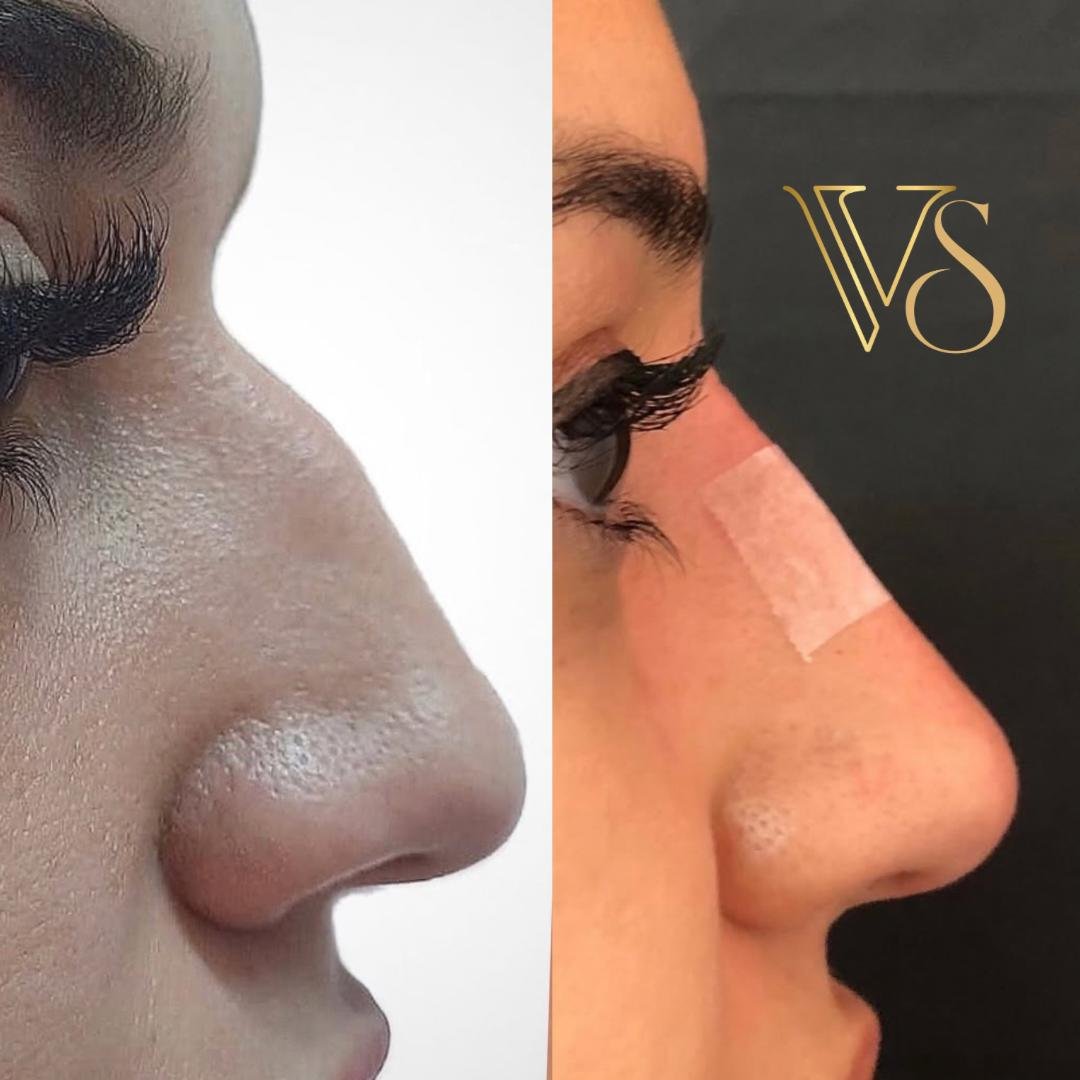 Rinomodelação com ácido hialurônico para refinamento do dorso e ponta nasal em Castro - Dra. Vanessa Silveira.