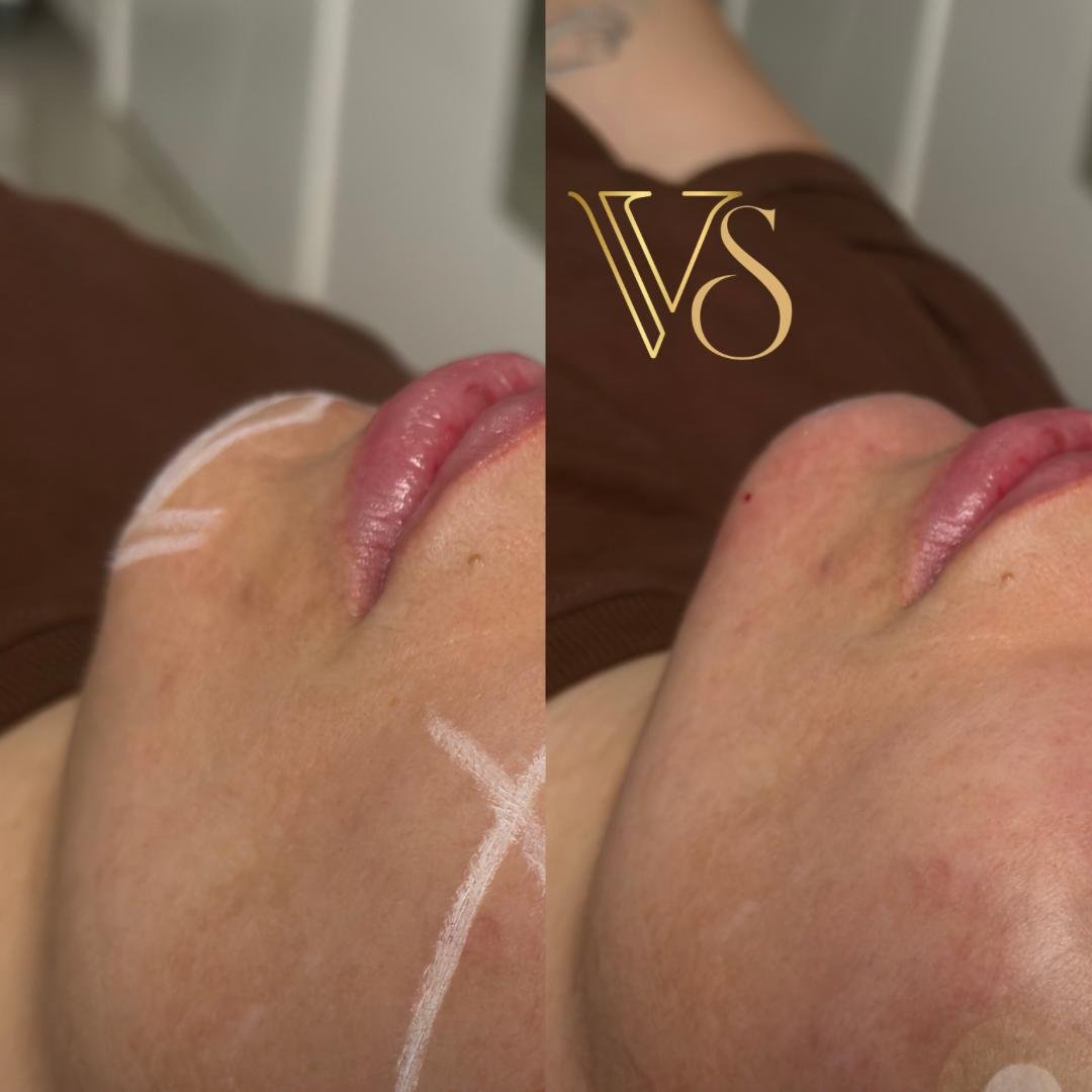 Preenchimento de mento Dra Vanessa Silveira Castro e Ponta Grossa