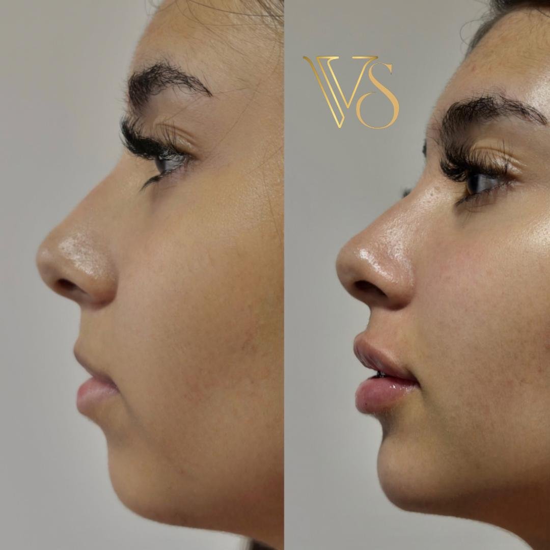 Resultado de Perfiloplastia em Castro: Refinamento de nariz, lábio e mento com naturalidade absoluta.