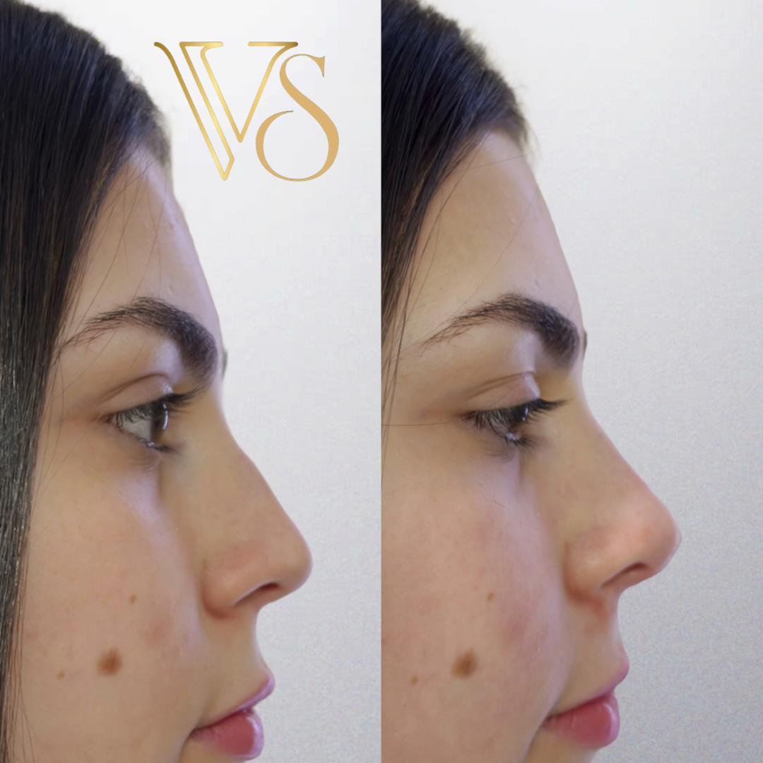 Rinomodelação natural Dra Vanessa Silveira Castro e Ponta Grossa