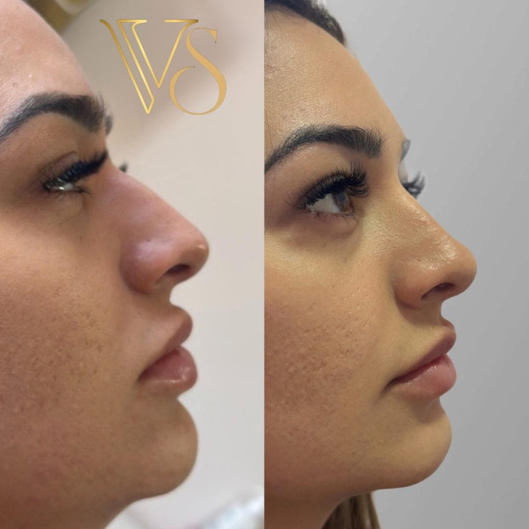 Análise de Perfiloplastia: Harmonização de nariz e mento para o equilíbrio do perfil facial - Dra. Vanessa Silveira.