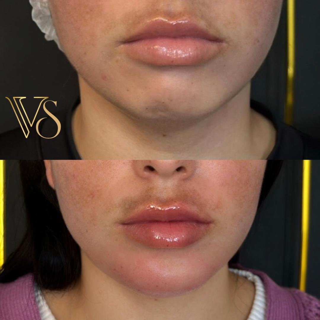 Mentoplastia Dra Vanessa Silveira Castro e Ponta Grossa