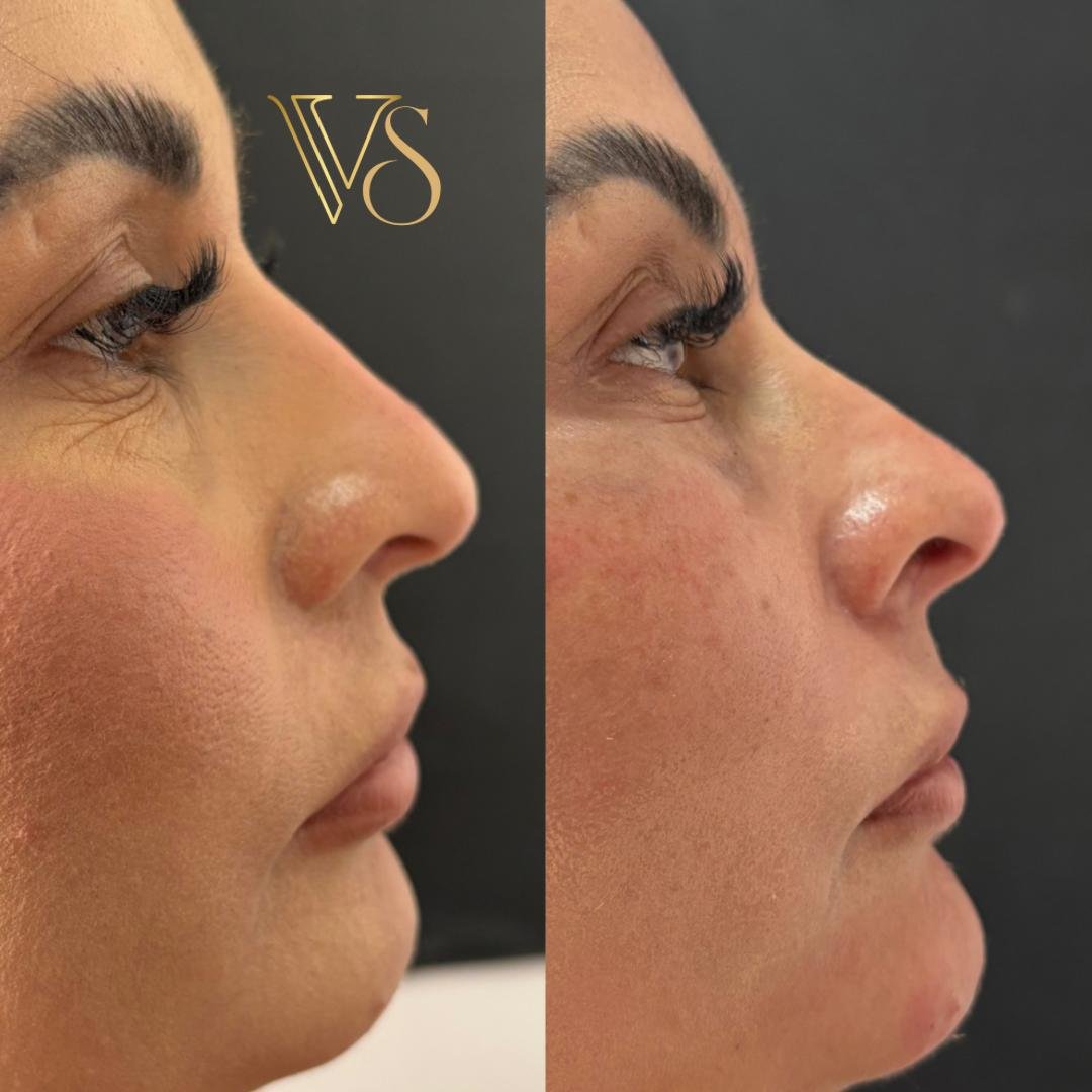 Análise de Perfiloplastia: Harmonização de nariz e mento para o equilíbrio do perfil facial - Dra. Vanessa Silveira.