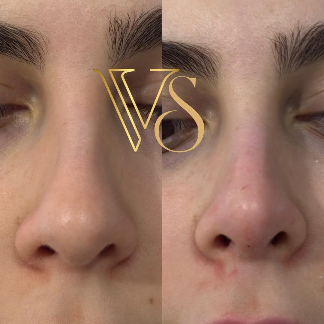 Preenchimento de olheiras natural Dra Vanessa Silveira Castro e Ponta Grossa