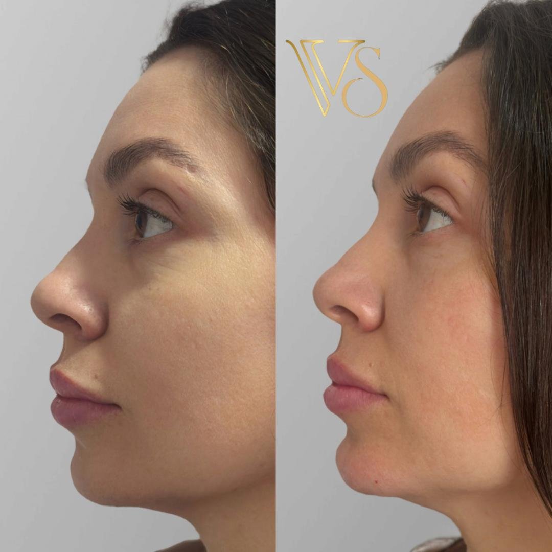 Preenchimento de mento Dra Vanessa Silveira Castro e Ponta Grossa