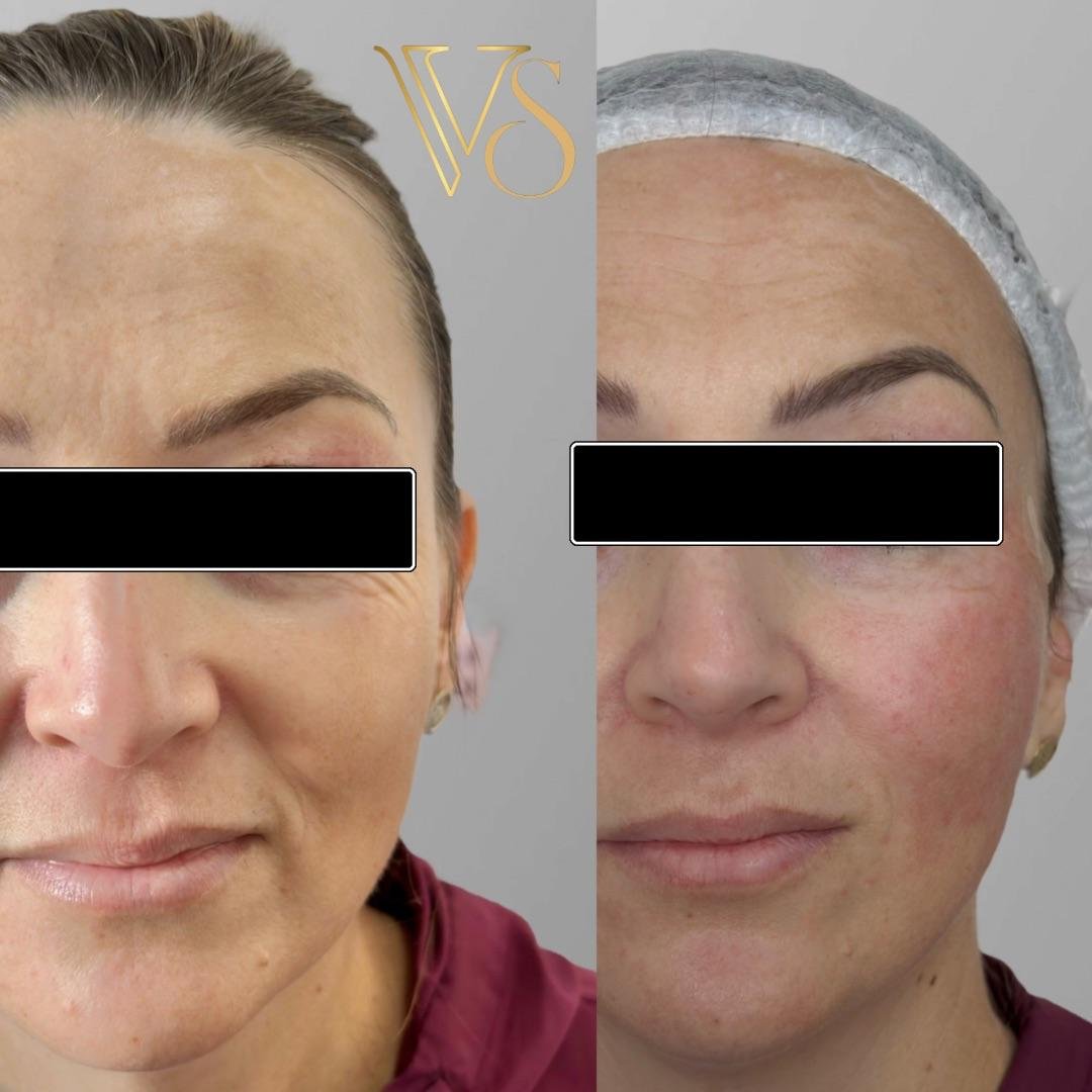 Efeito lifting sem plástica: Reposicionamento de tecidos e sustentação facial com naturalidade - Dra. Vanessa Silveira.