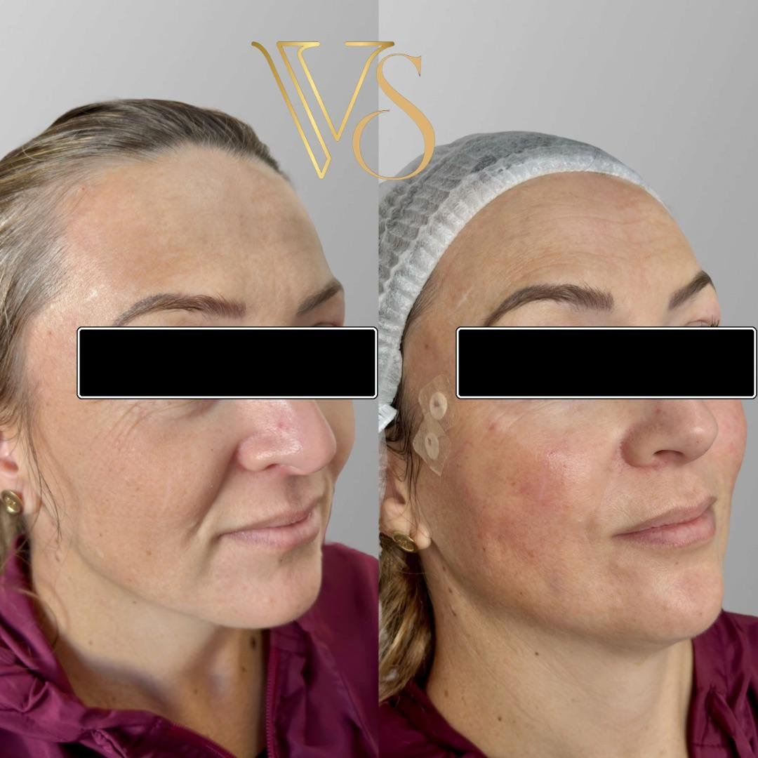 Efeito lifting sem plástica: Reposicionamento de tecidos e sustentação facial com naturalidade - Dra. Vanessa Silveira.