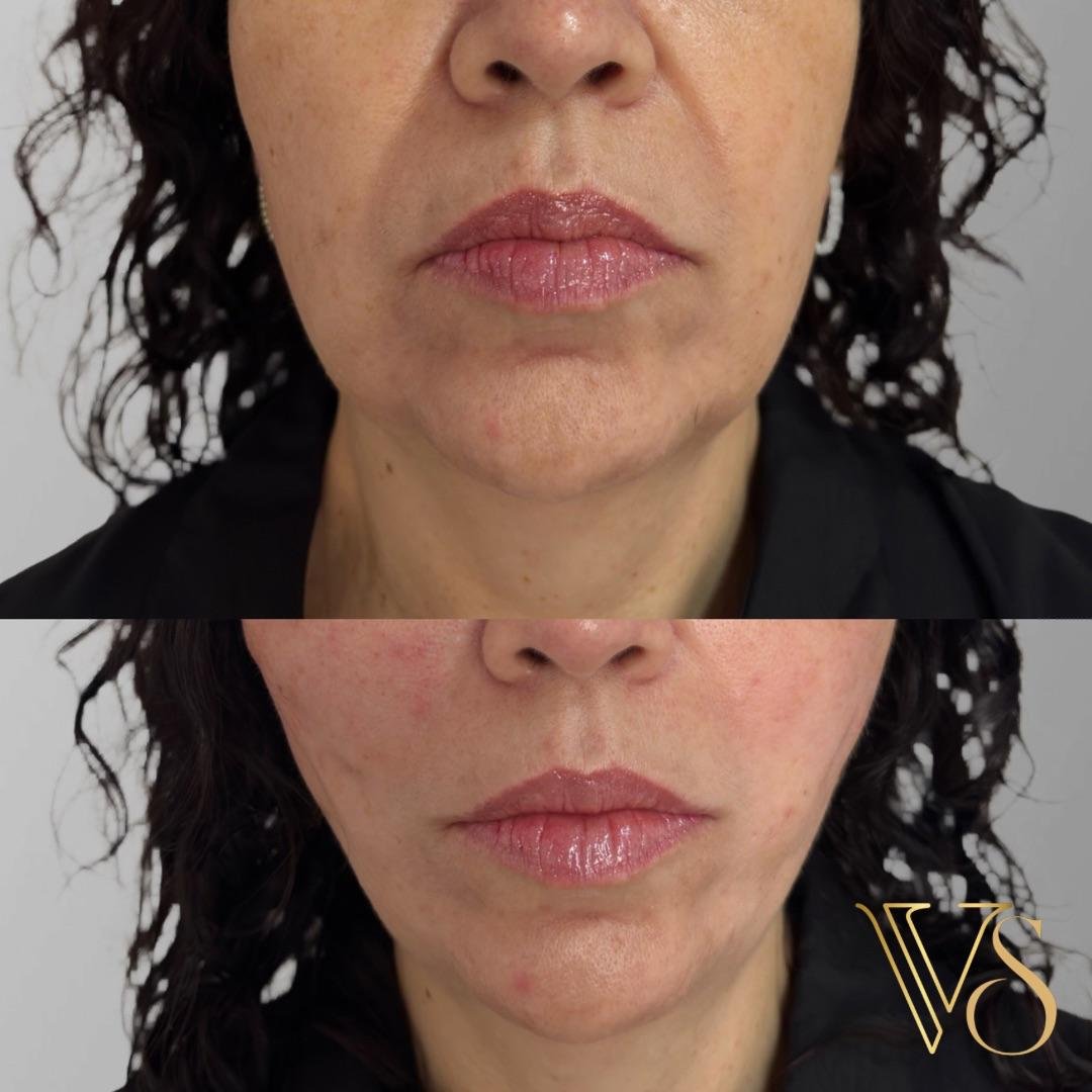 Efeito lifting sem plástica: Reposicionamento de tecidos e sustentação facial com naturalidade - Dra. Vanessa Silveira.