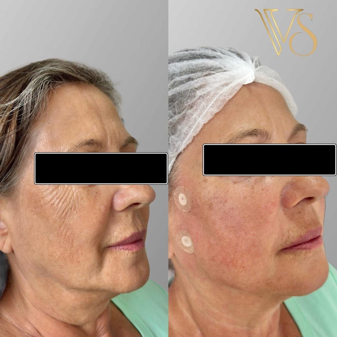 Efeito lifting sem plástica: Reposicionamento de tecidos e sustentação facial com naturalidade - Dra. Vanessa Silveira.