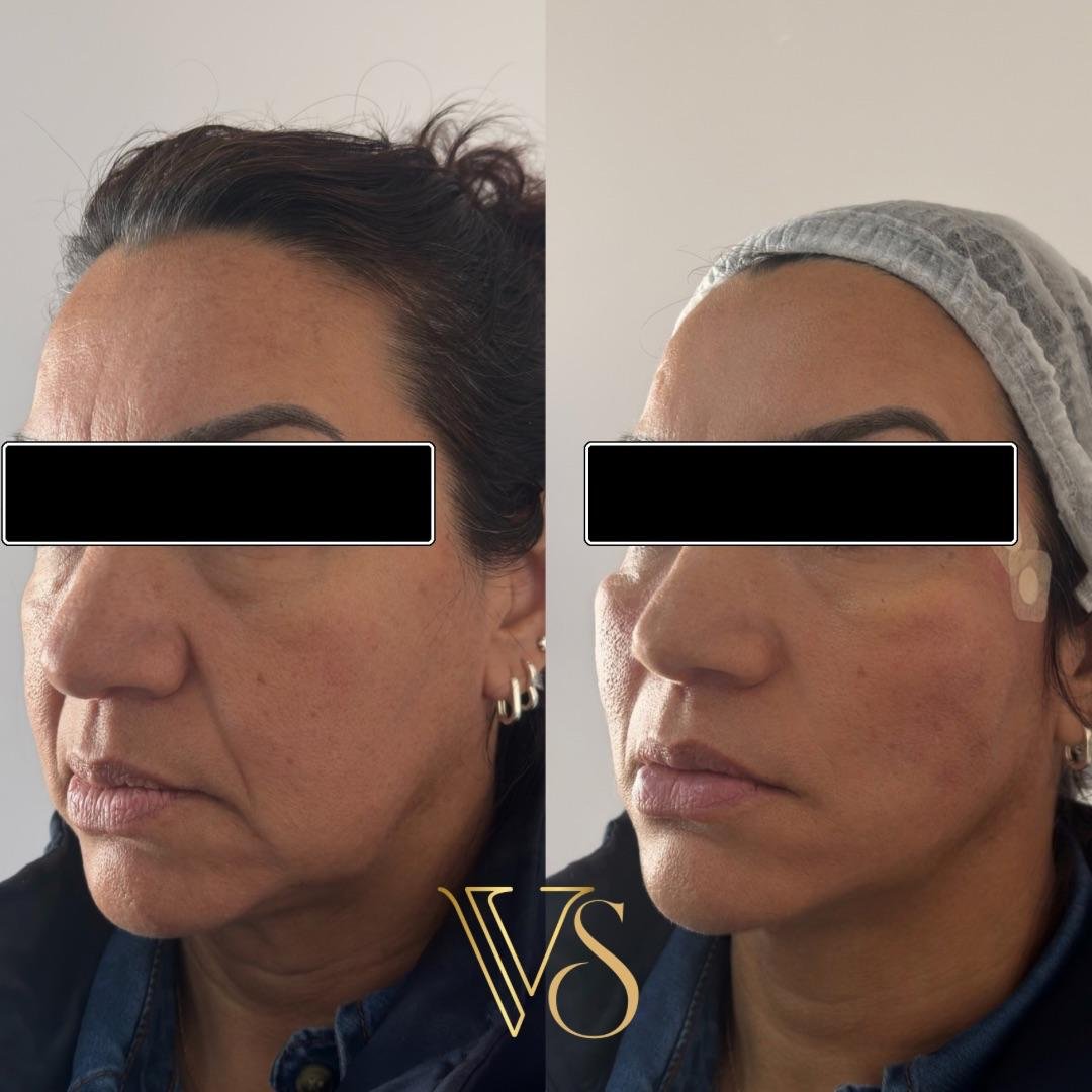 Efeito lifting sem plástica: Reposicionamento de tecidos e sustentação facial com naturalidade - Dra. Vanessa Silveira.