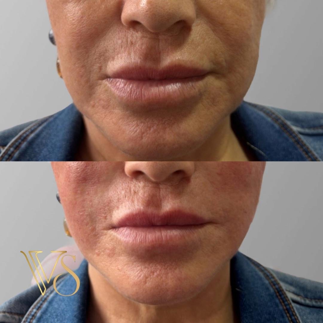 Lifting sem cirurgia para definição do contorno facial e tratamento da flacidez tecidual profunda.