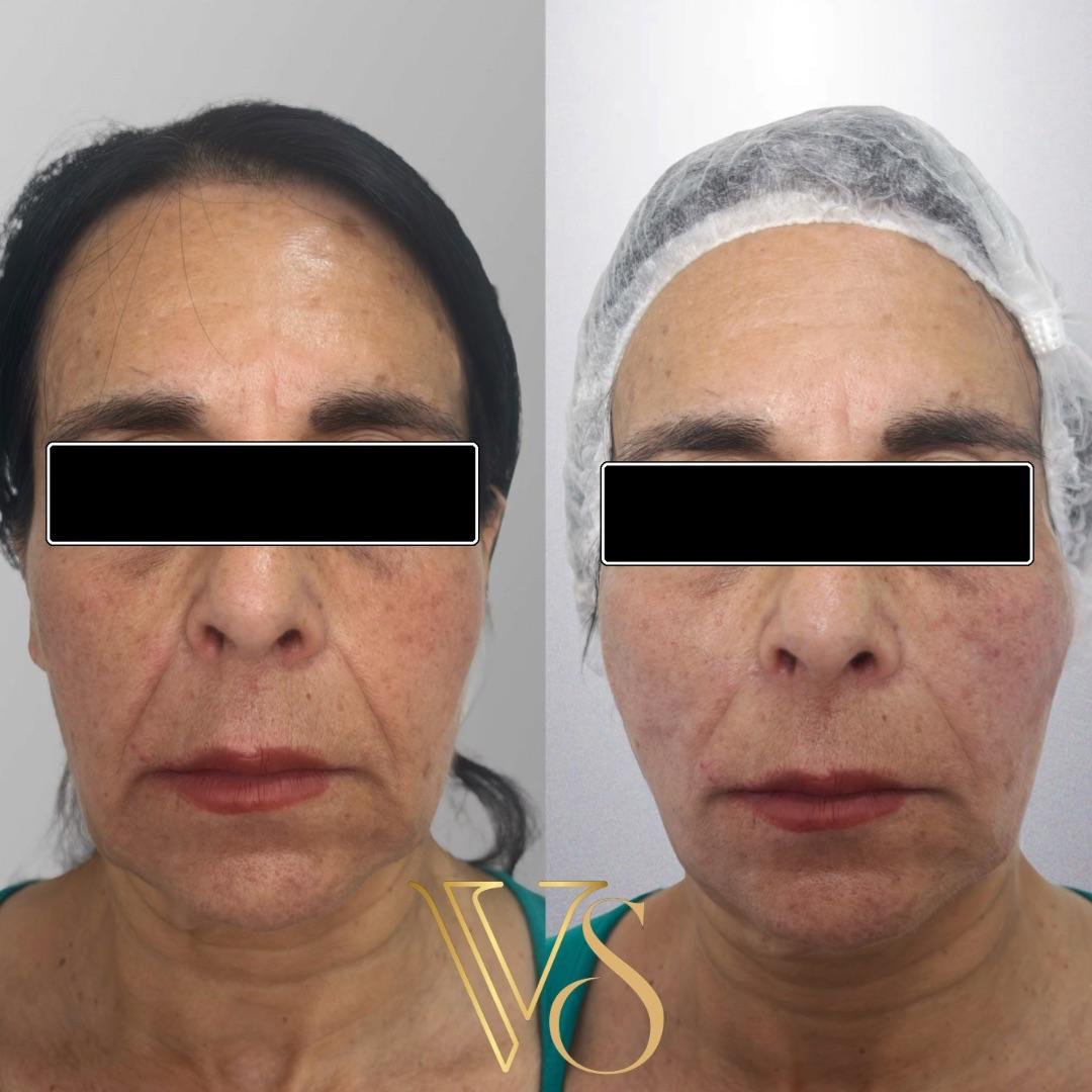 Lifting sem cirurgia para definição do contorno facial e tratamento da flacidez tecidual profunda.
