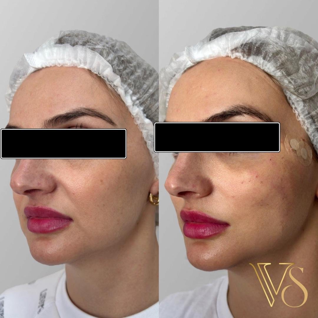 Lifting sem cirurgia para definição do contorno facial e tratamento da flacidez tecidual profunda.