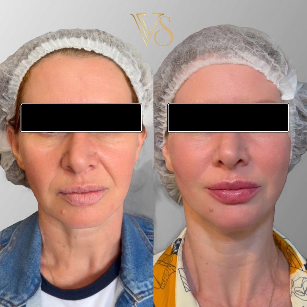 Lifting sem cirurgia para definição do contorno facial e tratamento da flacidez tecidual profunda.