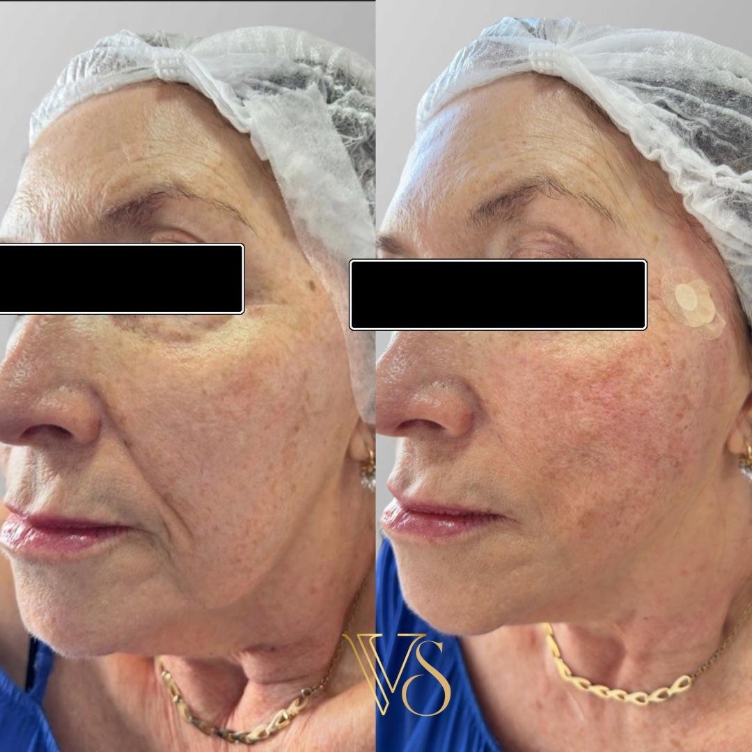 Lifting sem cirurgia para definição do contorno facial e tratamento da flacidez tecidual profunda.