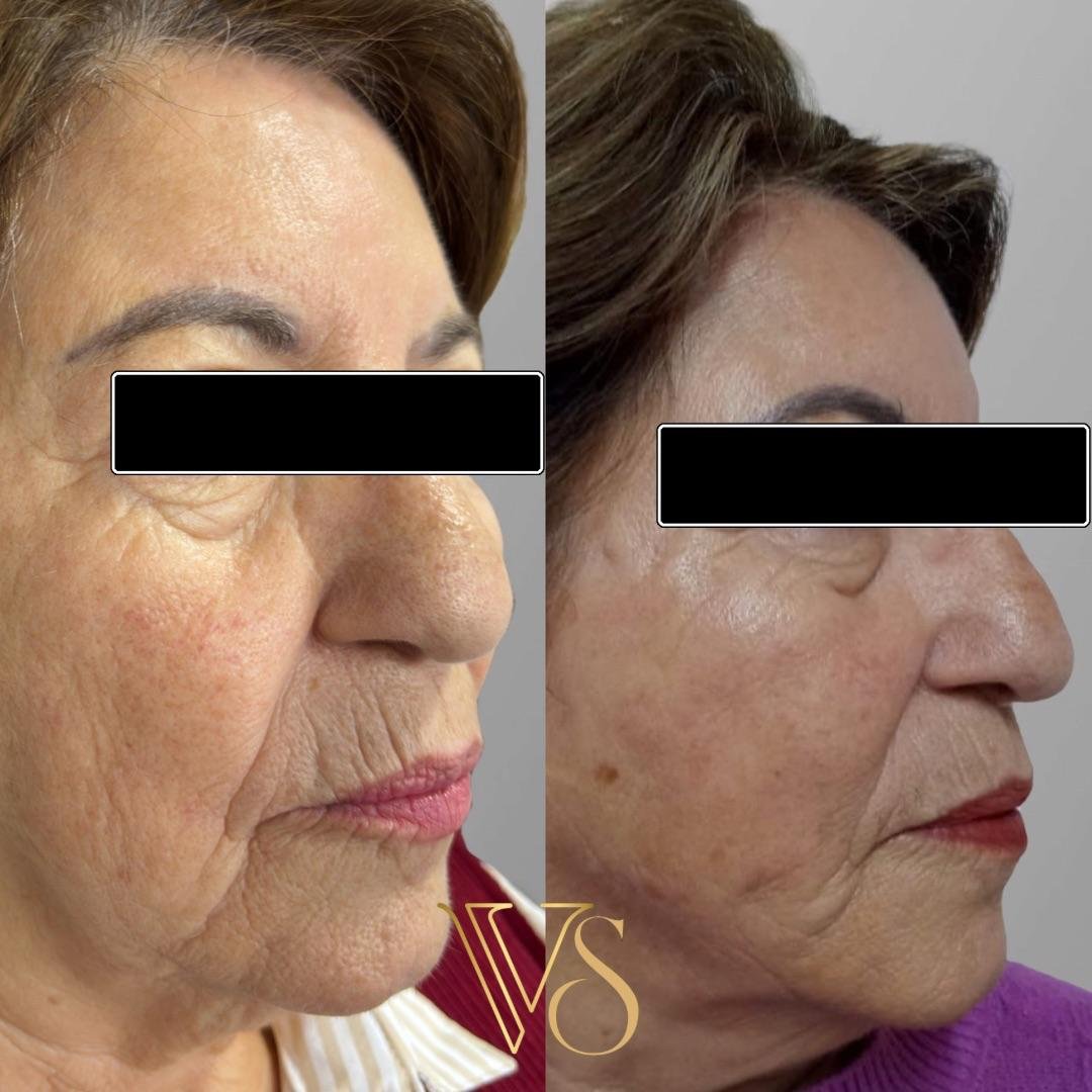 Efeito lifting sem plástica: Reposicionamento de tecidos e sustentação facial com naturalidade - Dra. Vanessa Silveira.