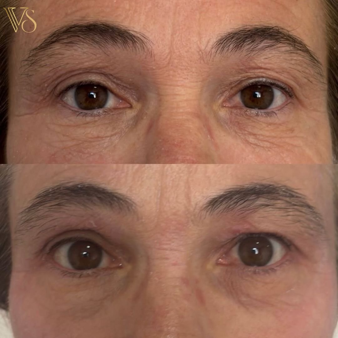 Tratamento para rugas microfocado e peeling profundo Dra Vanessa