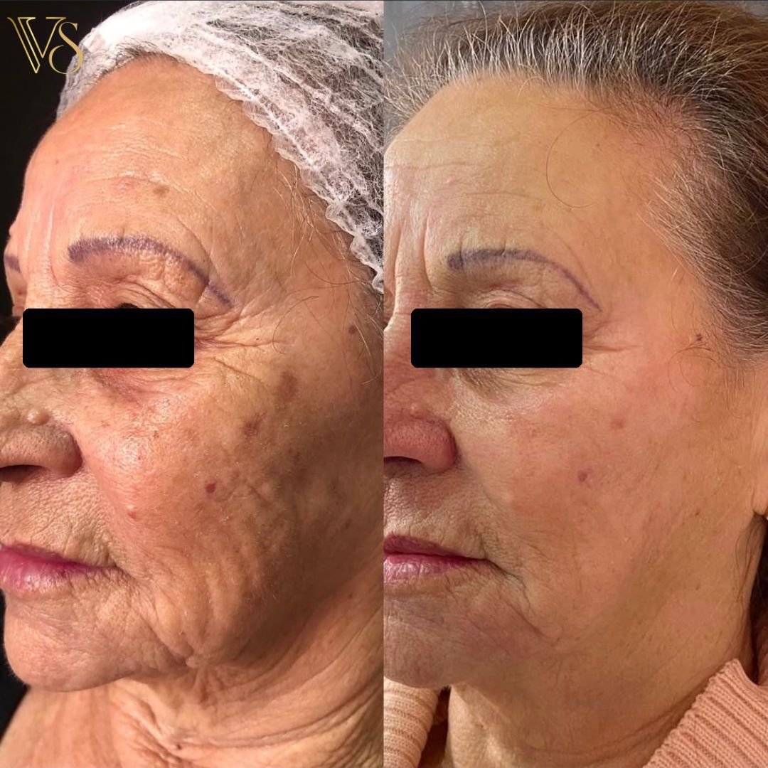 Tratamento para rugas microfocado e peeling profundo Dra Vanessa