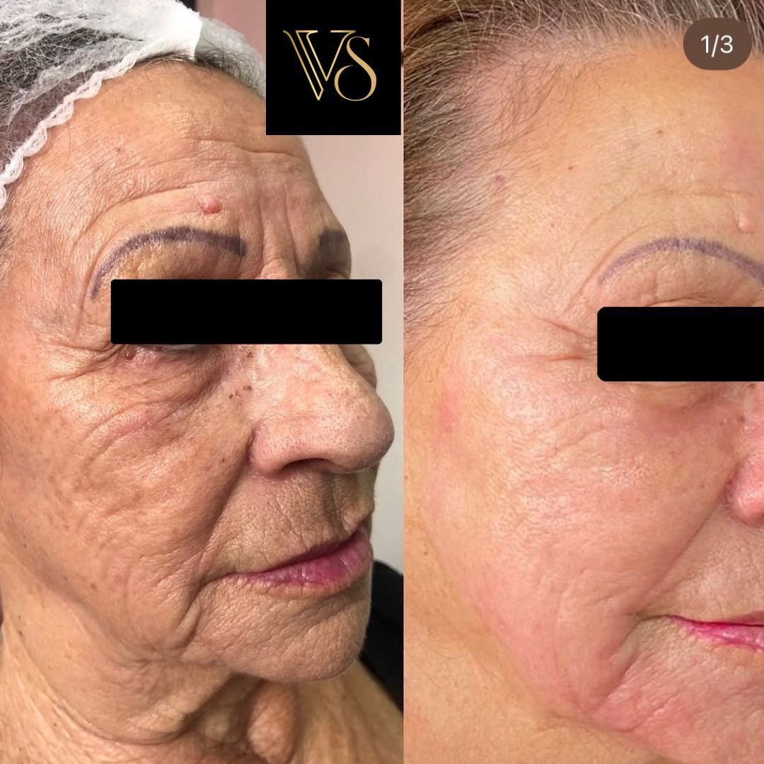 Tratamento para rugas microfocado e peeling profundo Dra Vanessa