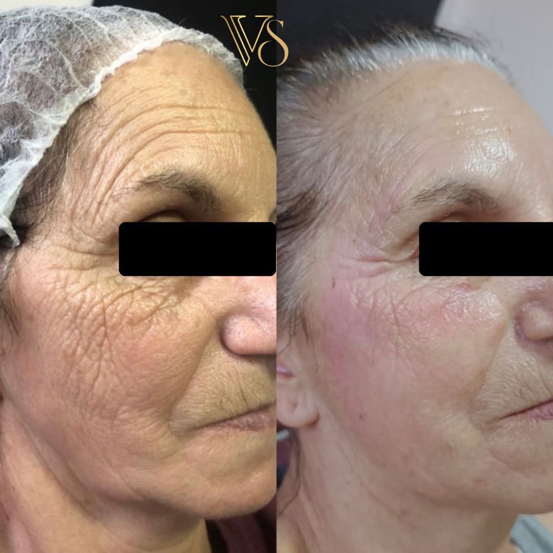 Tratamento para rugas microfocado e peeling profundo Dra Vanessa