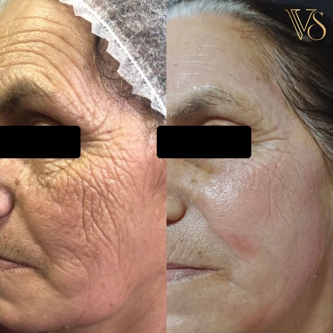 Tratamento para rugas microfocado+peeling profundo Dra Vanessa