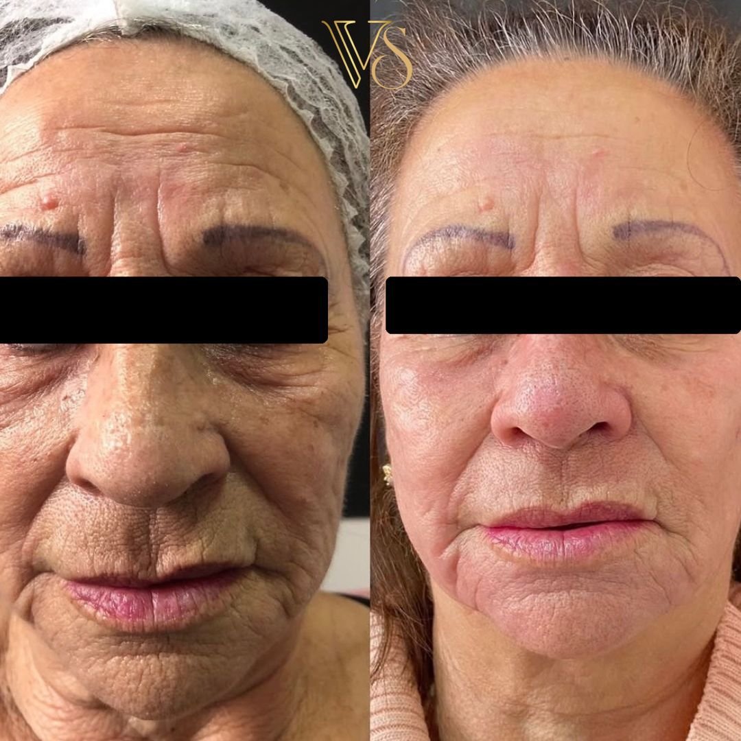 Tratamento para rugas microfocado+peeling profundo Dra Vanessa