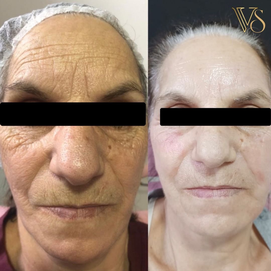 Tratamento para rugas microfocado+peeling profundo Dra Vanessa