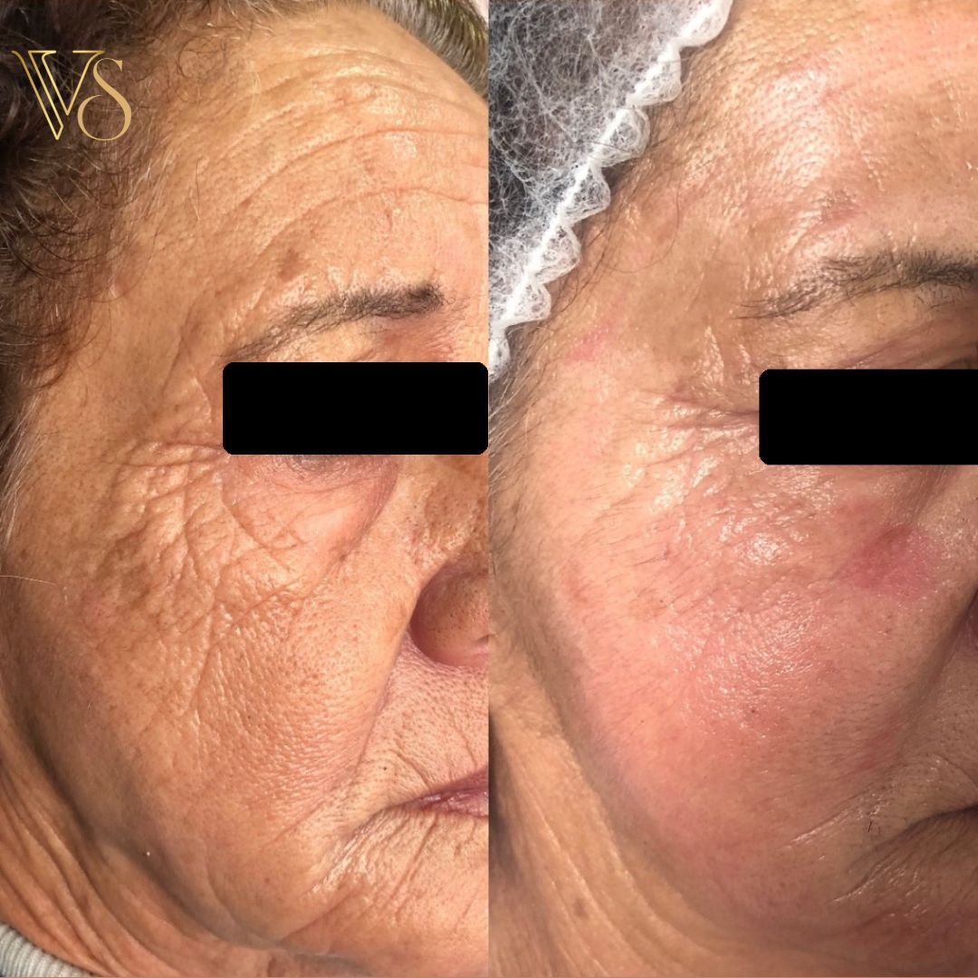 Tratamento para rugas peeling profundo Dra Vanessa
