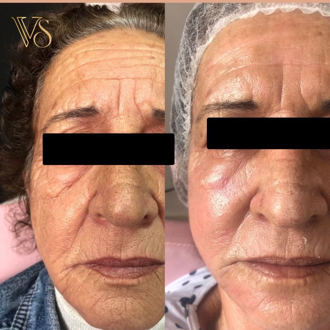 Tratamento para rugas microfocado + peeling Dra Vanessa