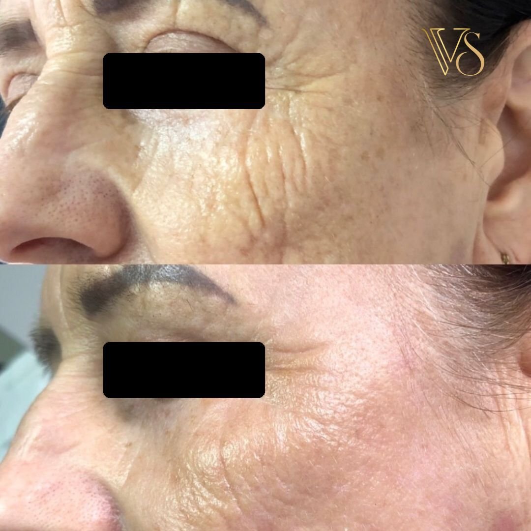 Tratamento para rugas peeling profundo Dra Vanessa