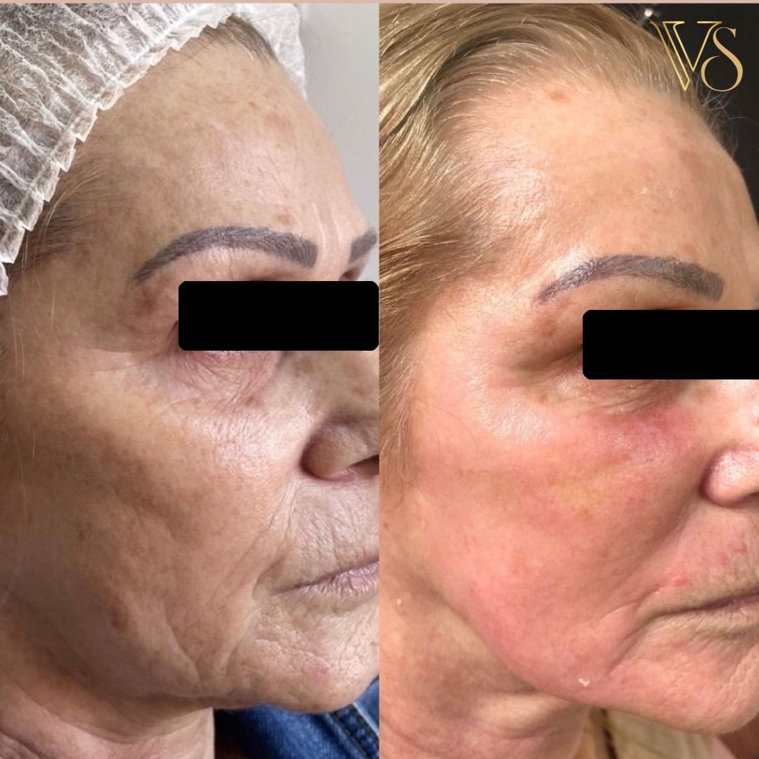 Tratamento para rugas peeling + bioestimulador Dra Vanessa
