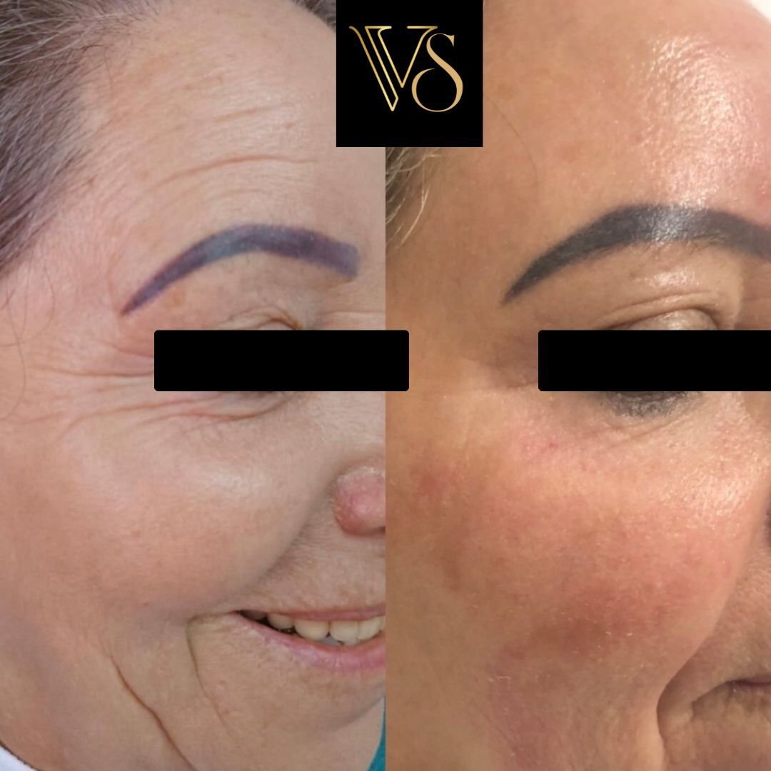 Tratamento para rugas microfocado + peeling Dra Vanessa