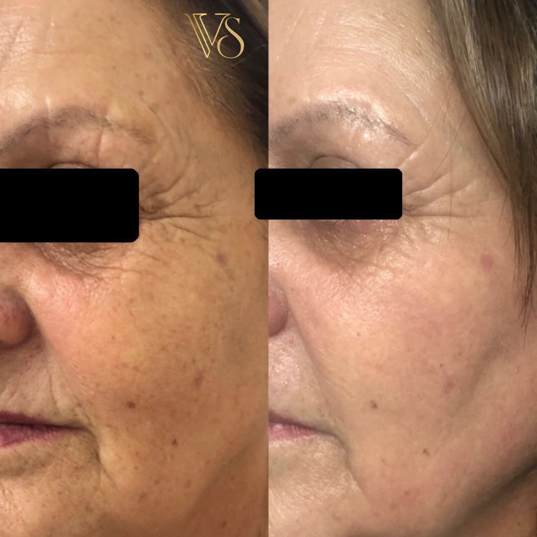 Tratamento para rugas microfocado + peeling Dra Vanessa