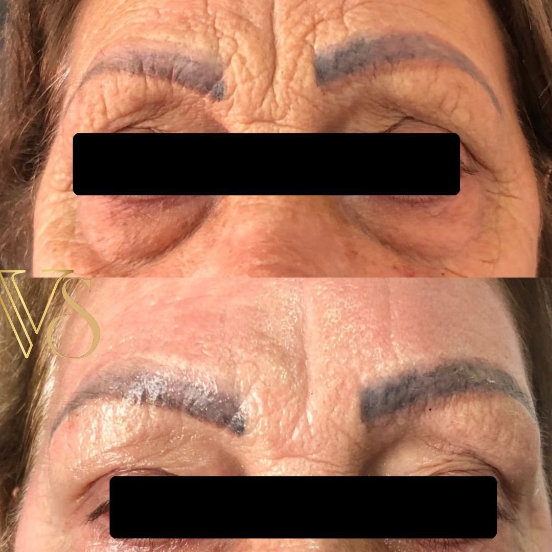 Tratamento para rugas peeling profundo Dra Vanessa
