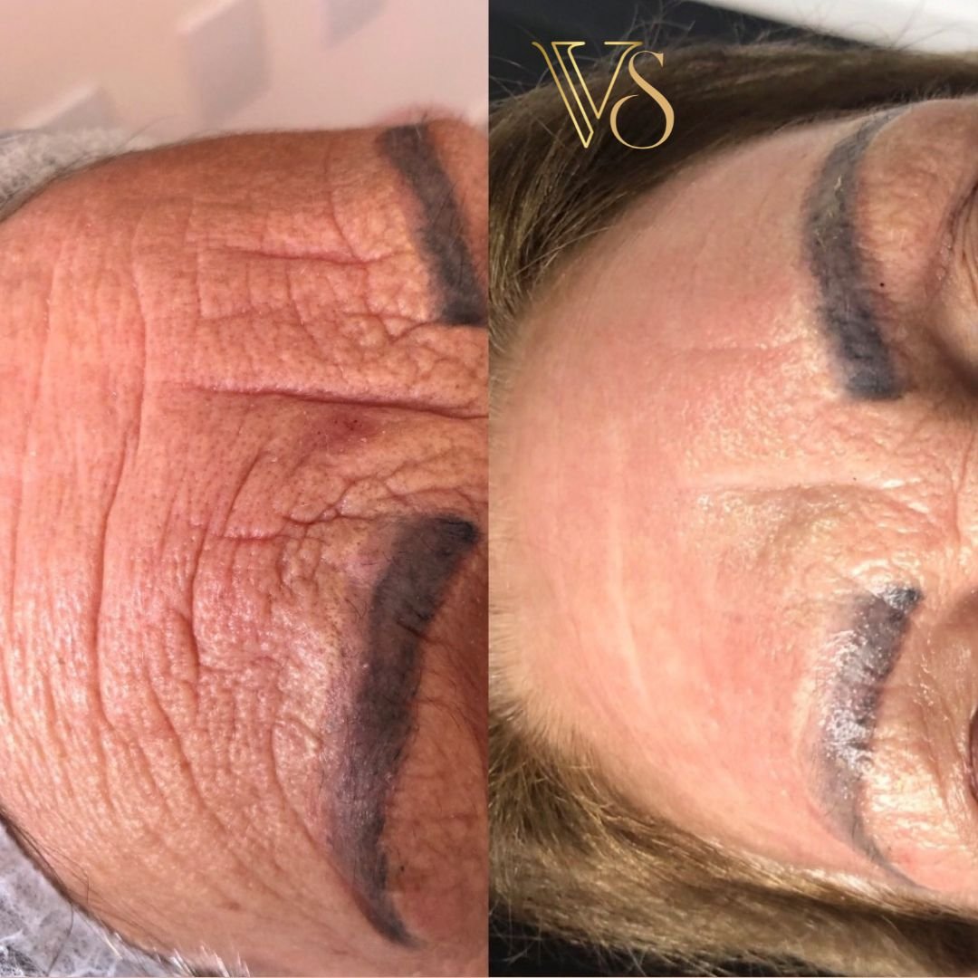 Tratamento para rugas peeling profundo Dra Vanessa