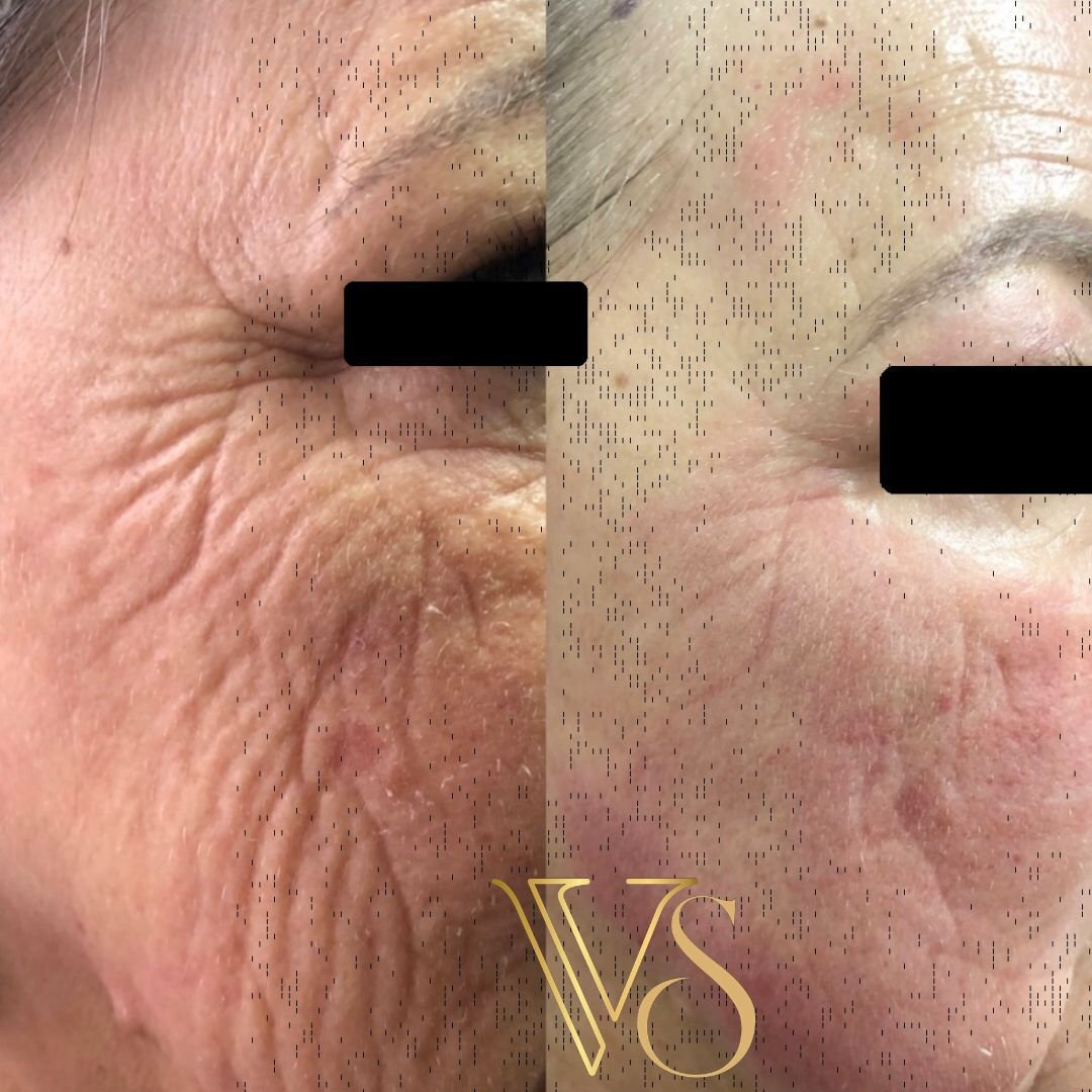 Tratamento para rugas peeling profundo Dra Vanessa