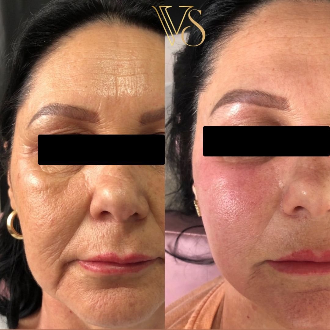 Tratamento para rugas e manchas peeling Dra Vanessa Silveira
