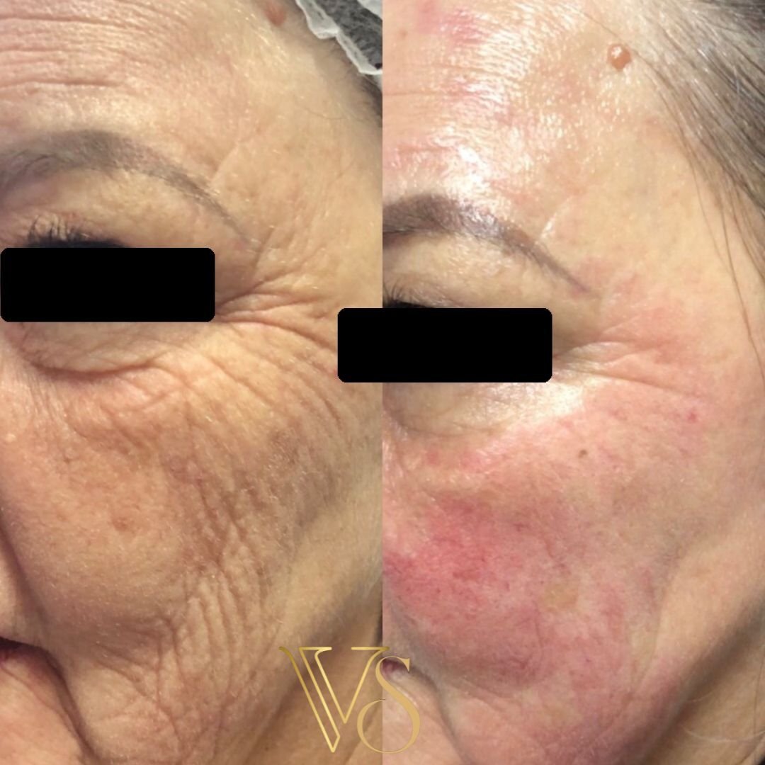 Tratamento para rugas peeling profundo Dra Vanessa