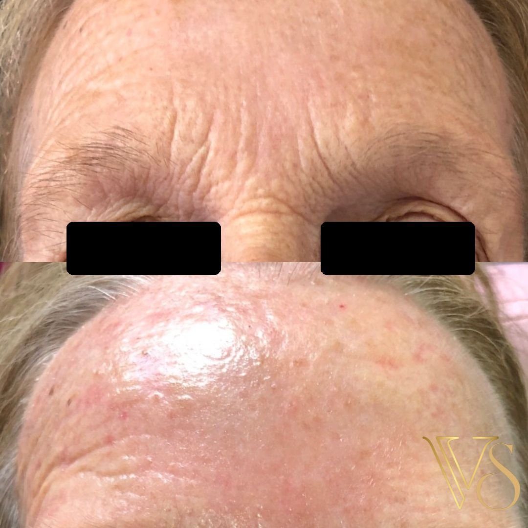 Tratamento para rugas peeling profundo Dra Vanessa