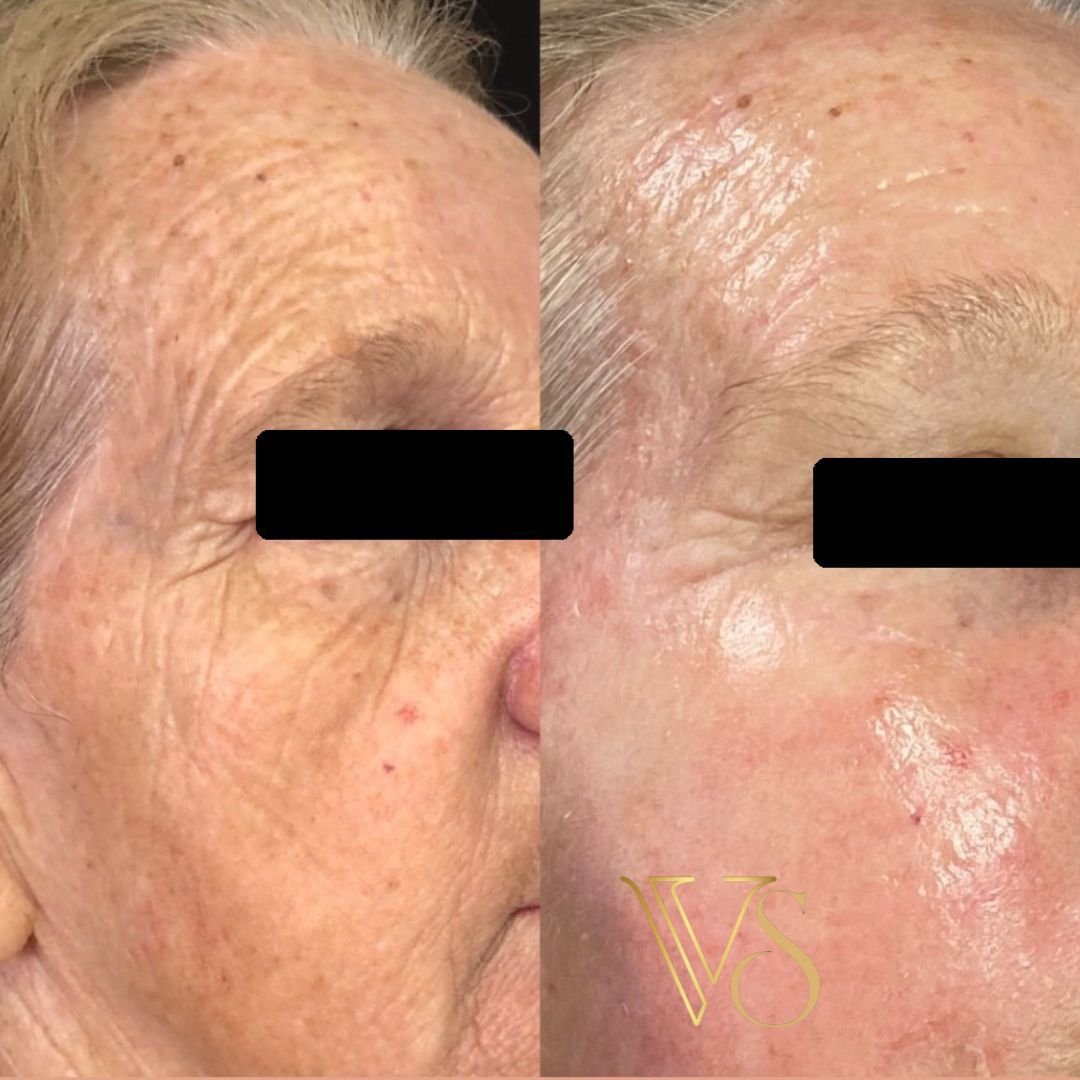 Tratamento para rugas peeling profundo Dra Vanessa