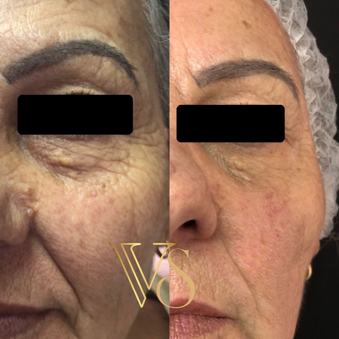 Tratamento para rugas profundas Dra Vanessa Silveira
