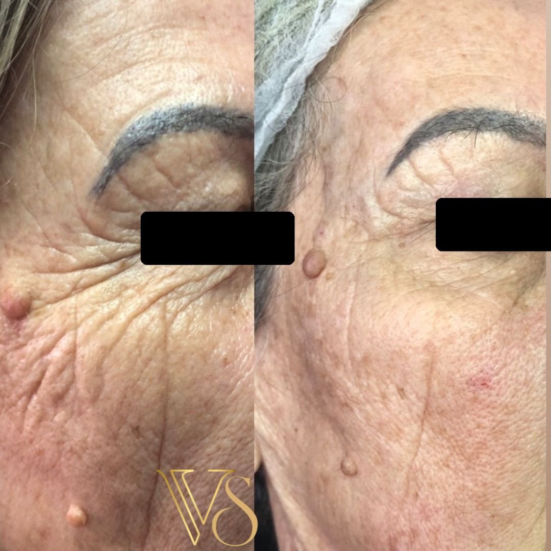 Tratamento para rugas profundas Dra Vanessa Silveira