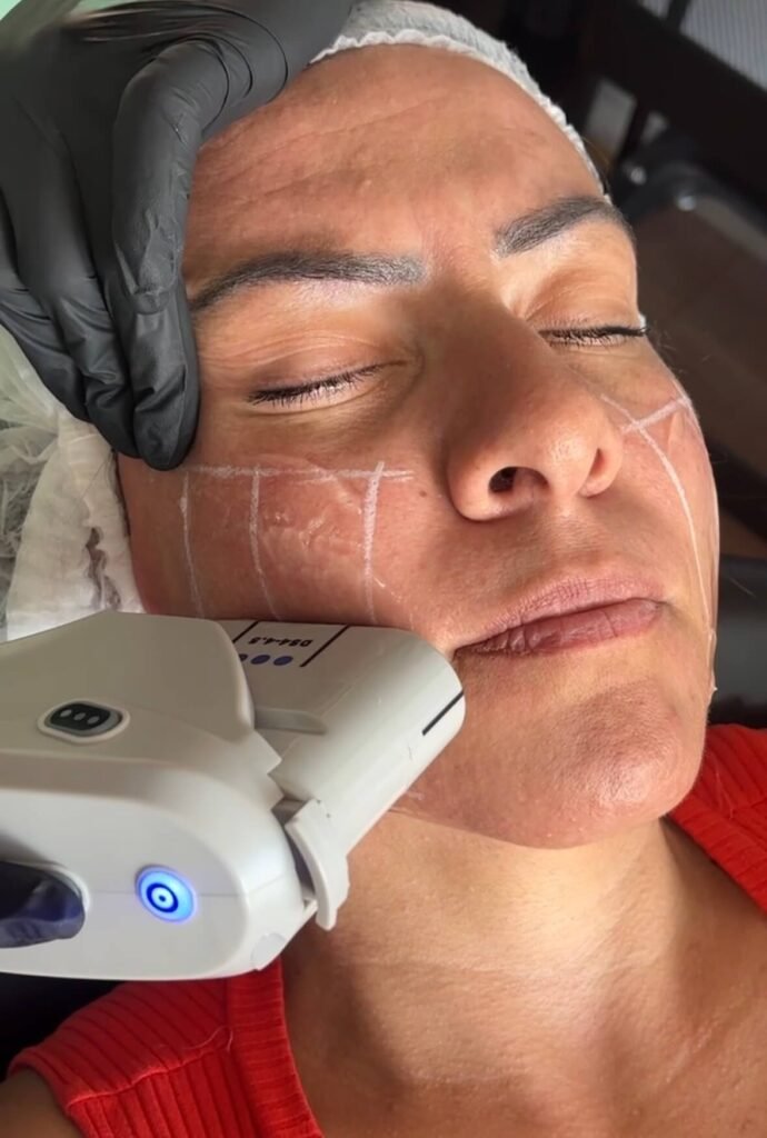 Tratamento para flacidez pos emagrecimento Dra Vanessa Silveira