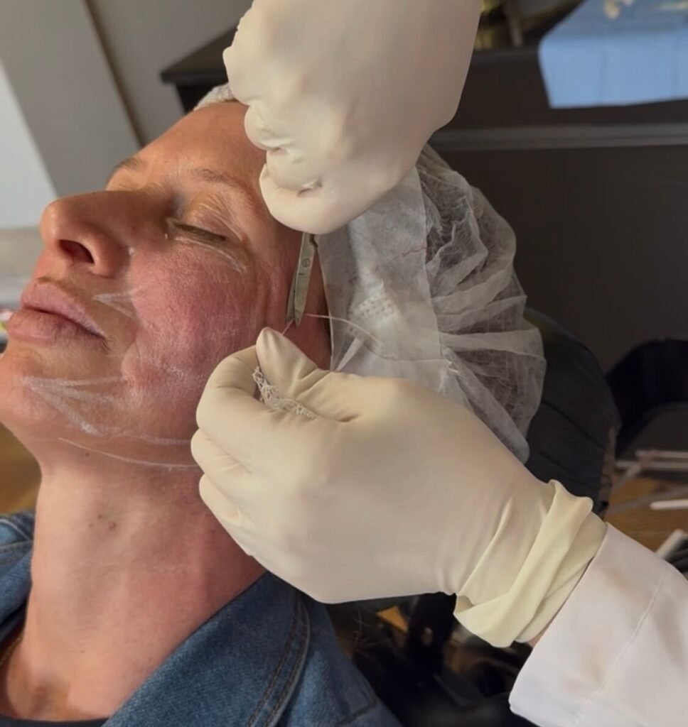 Lifting facial sem cirurgia - Dra Vanessa Silveira em Castro e Ponta Grossa