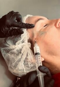 Bioestimulador de colageno em Castro - Dra Vanessa Silveira