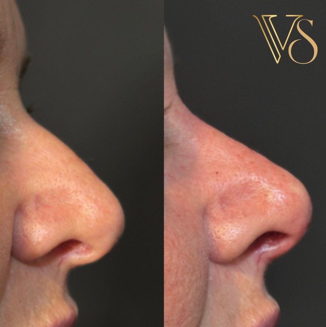 Rinomodelação estruturada sem preenchimento Dra Vanessa Silveira Castro e Ponta Grossa