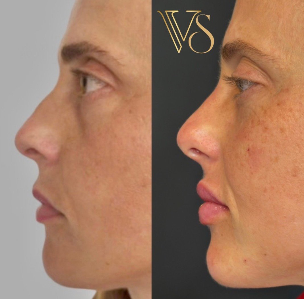 Análise de Perfiloplastia: Harmonização de nariz, labio e mento para o equilíbrio do perfil facial - Dra. Vanessa Silveira.