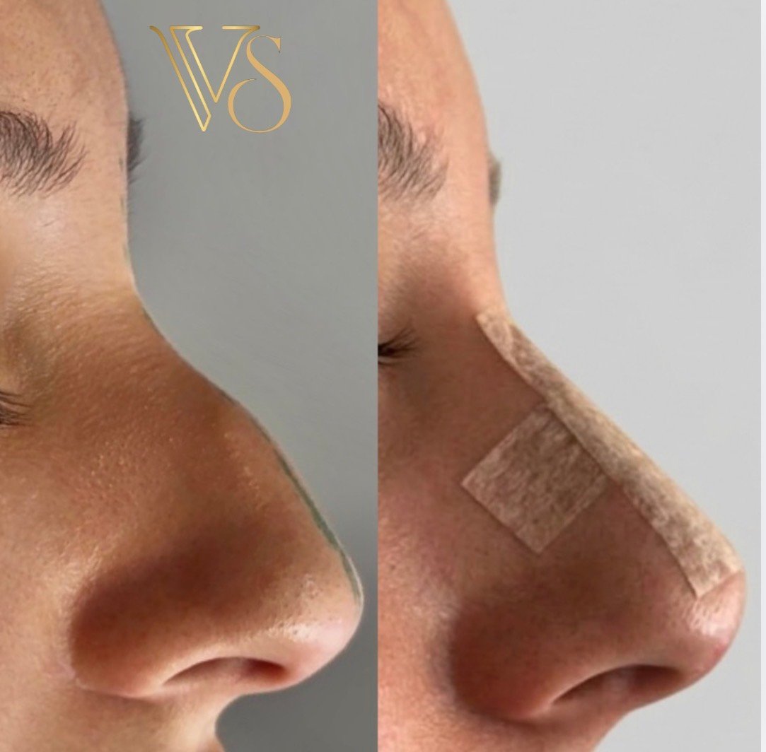 Nariz sem plastica Dra Vanessa Silveira Castro e Ponta Grossa