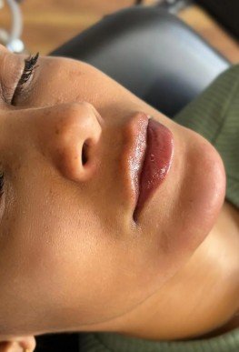 Perfiloplastia em castro pr Dra Vanessa Silveira